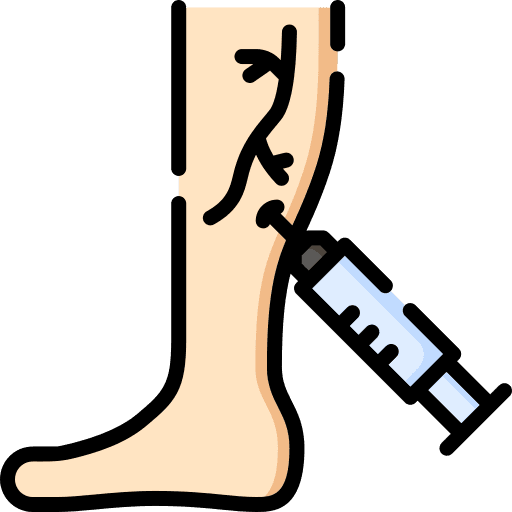 Varicose veins